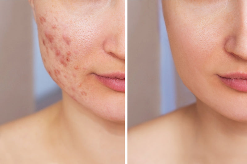 Acne - Causes & Treatments